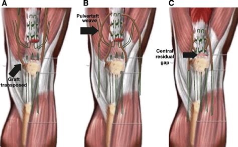 Surgical Treatment of Chronic Rupture of the Quadriceps Using a Modified Pulvertaft Weave ...