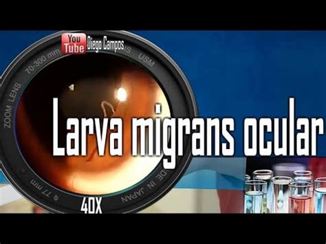 Larva migrans Ocular(toxocariasis)- Observación del parasito en el ojo. - YouTube