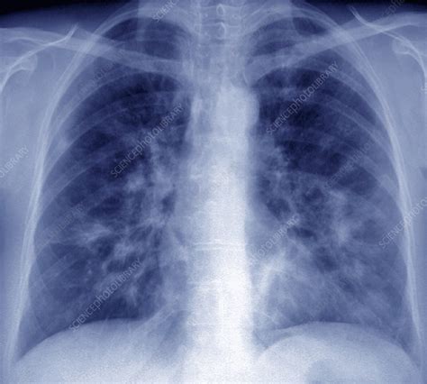 Diffuse interstitial pneumonia, lung X-ray - Stock Image - C038/4544 - Science Photo Library