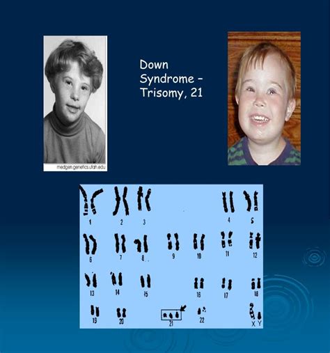 Trisomy 21 Down Syndrome - Down Syndrome (Trisomy 21) : A child with down syndrome also may have ...