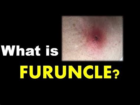 What is Furuncle, Abscess or Boil in Dermatology - YouTube in 2020 ...