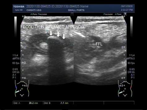 Ultrasound Video showing Fecolith in Appendix. - YouTube