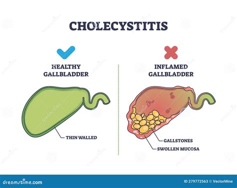 Cholecystitis As Inflamed Gallbladder Compared with Healthy Outline ...