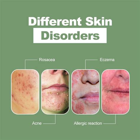 different skin disorders Natural Remedies For Rosacea, Rosacea Remedies, Rosacea Diet, Acne ...