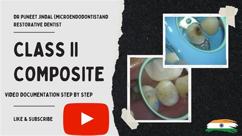 class 2 composite restoration (STEP BY STEP) video documentation | How to get a tight contact ...