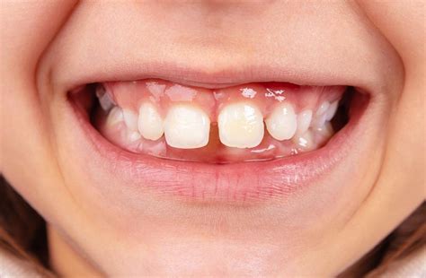 Treatment Options For Fixing a Gap Between Teeth : Tompkins Dental: General Dentistry