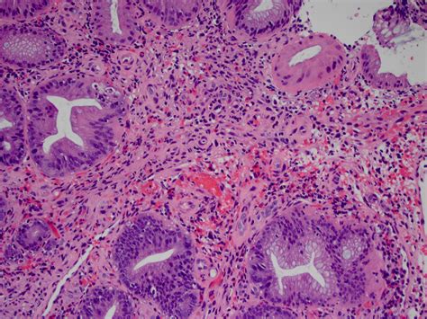 Pathology Outlines - Kaposi sarcoma