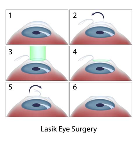 Does LASIK Hurt? What to Expect During and After Surgery