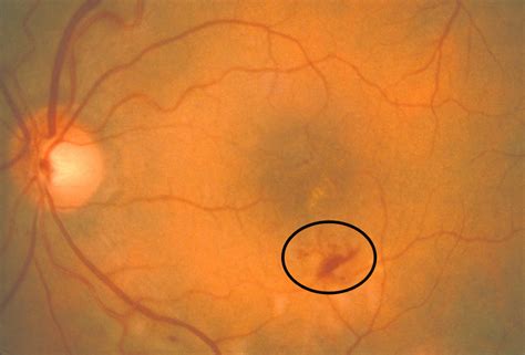 Intraretinal Hemorrhage