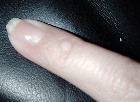 What is this lump on my finger? | Mumsnet