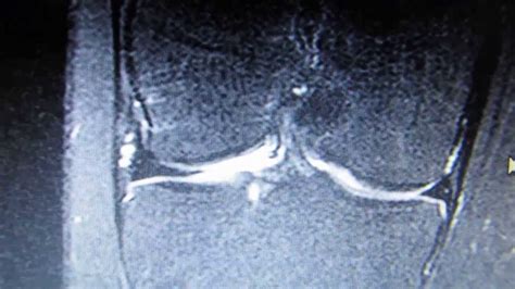 Mri scan of knee injury - YouTube