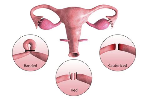 Understanding Laparoscopic Tubal Ligation