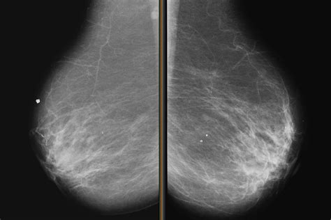 A New and Improved Mammogram? | Reader's Digest