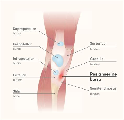 Pes anserine bursitis - Injurymap