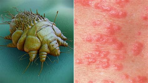 How to Know if Those Bites Are Scabies | Everyday Health