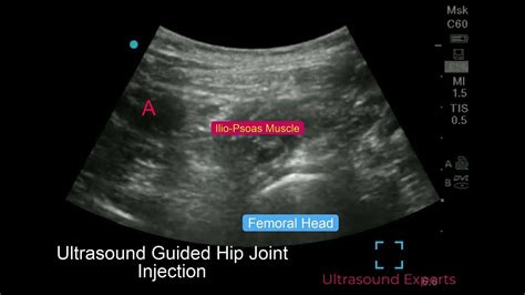 Ultrasound Guided Hip Joint Injection - YouTube