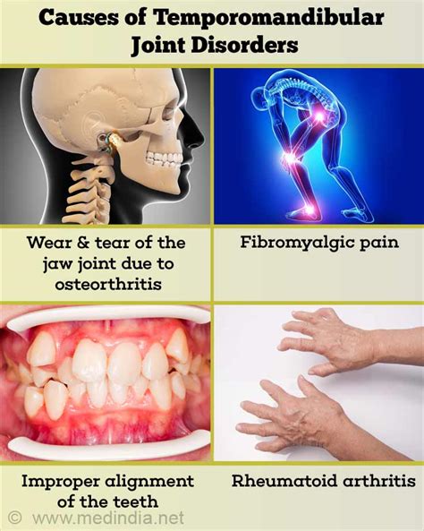 Temporomandibular Joint Disorders - Causes, Symptoms, Diagnosis & Treatment