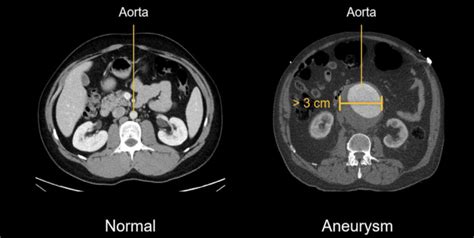 Abdominal CT: aortic aneurysm • LITFL • Radiology Library