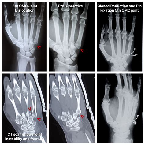 Closed Reduction and Pin Fixation of Hand Fracture-Dislocation - John ...