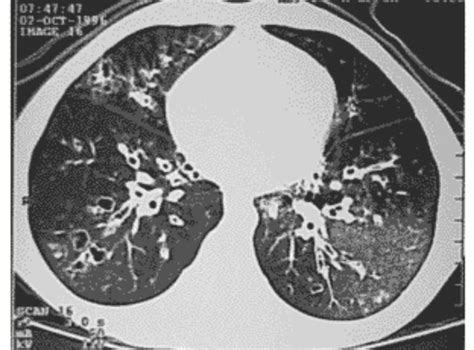 Bronchiolitis obliterans (popcorn lung) - MEDizzy