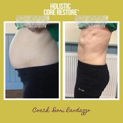 Before & After Diastasis Recti Repair Gallery - Holistic Core Restore