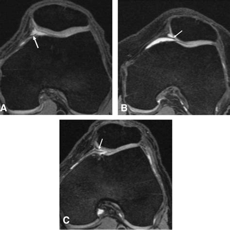 Type C mediopatellar plica with cartilage damage and BMLs in the medial ...