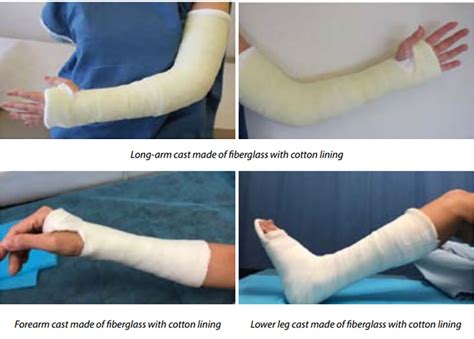 Care of Casts and Splints - FV Hospital