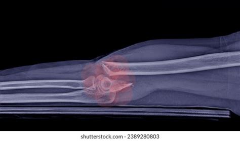 X-ray Image Arm Revealed Fracture Express Stock Photo 2389280803 ...