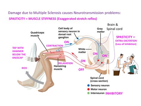 Multiple Sclerosis Research: A potential new treatment for spasticity