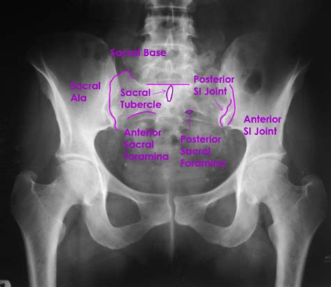 Sacral Foramina Xray