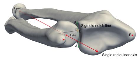 Bony landmarks, bone axis, and kinematic outcome measures on CT-based ...