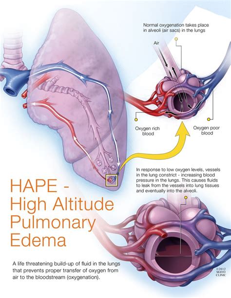 HAPE – High Altitude Pulmonary Edema | Mayo on Everest | Pinterest | The o'jays, Science and Health