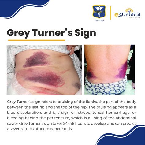 DBMCI Egurukul - Grey Turner's sign refers to bruising of...