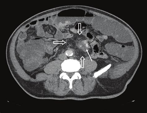 Figure 1. Abdominal CT scan in an axial view after intravenous contrast ...