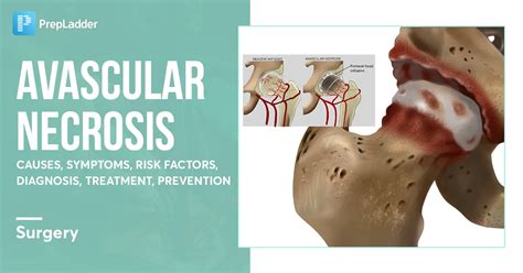 Avascular Necrosis: Causes, Symptoms and Risk Factors