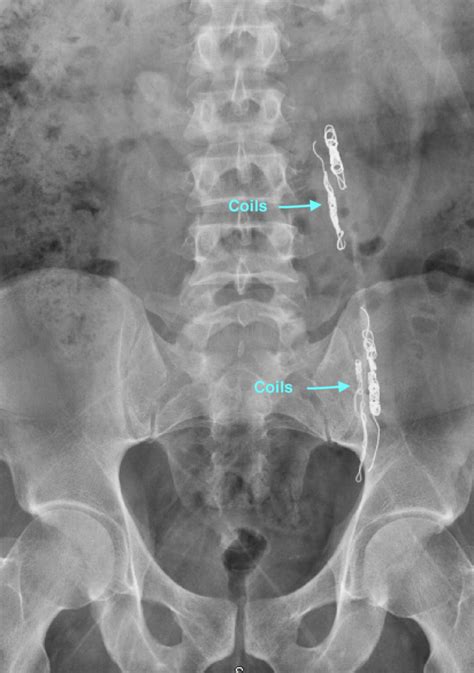 Scrotal Varicocele / Infertility - Gonadal Vein Embolization