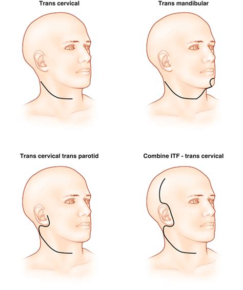 Approaches to the Parapharyngeal Space | Plastic Surgery Key