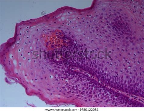 Squamous Cell Papilloma Lower Third Esophagus Stock Photo 1980122081 | Shutterstock