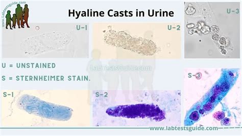 Hyaline Casts: Definition, Causes, Significance, and Clinical Correlations