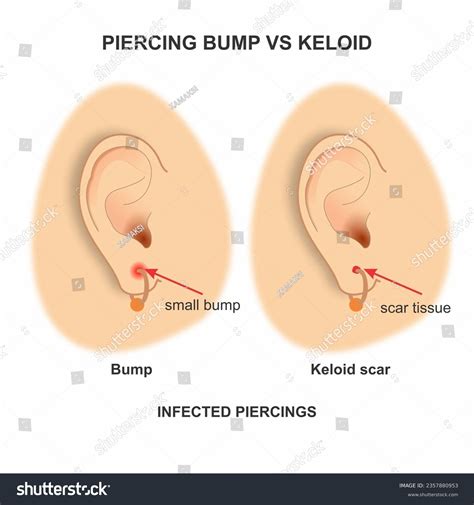 Piercing Bump Vs Keloid Illustration Ear Stock Illustration 2357880953 | Shutterstock