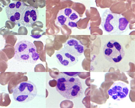 Hyposegmented Neutrophils