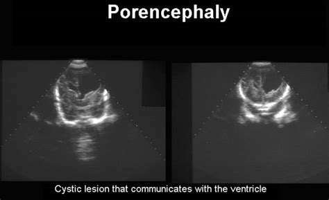 Hydranencephaly And Porencephaly