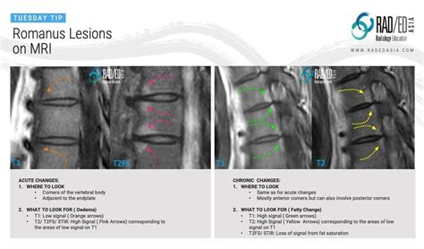 ROMANUS LESION MRI FINDINGS CORNER INFLAMMATORY LESIONS - Radedasia