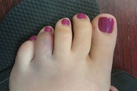 What Do Broken Toes Look Like | Apps Directories