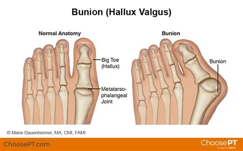 Guide | Physical Therapy Guide to Bunion (Hallux Valgus) | Choose PT