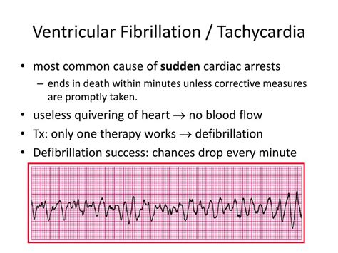 Ventricular Tachycardia Vs Fibrillation