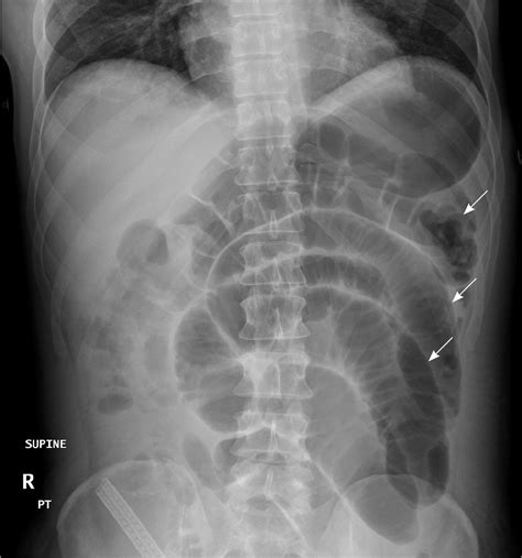 Bowel Obstruction - Small & Large - Causes, Symptoms, Treatment