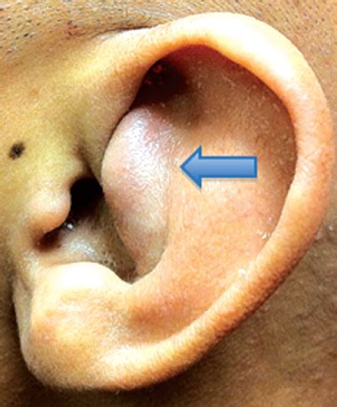 Diseases of the External Ear | Ento Key