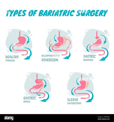 Types of bariatric surgery, it is process for the digestive system in stomach, A new types of ...