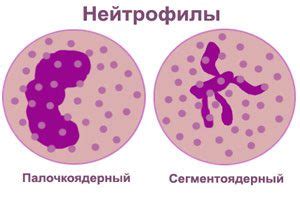 Neutrophilia: symptoms and treatment – Healthy Food Near Me